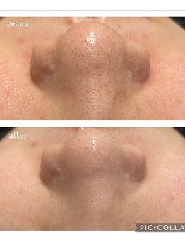 コンフィデンスサロン(Confidence Salon)/毛穴の黒ずみケア！