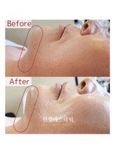 エクリア(ECLIA)/レッドショット2cc×EMS