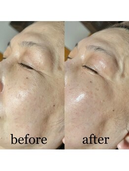 エルミオ エスパシオ ミロク(El mio espacio 369miroku)/カーボキシー～お顔編～