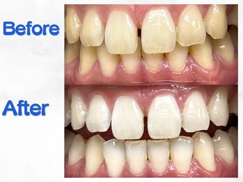 LBSホワイトニング 梅田店/ホワイトニングビフォーアフター