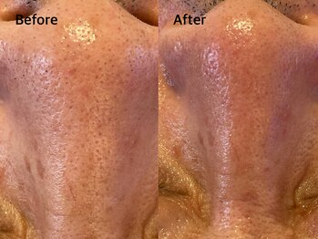 アンベリール(Embellir)/毛穴洗浄beforeafter