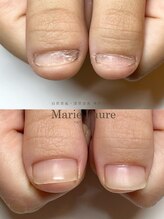 マリーロール 梅田店(Marie Laure)/自爪育成/深爪矯正/ネイルケア