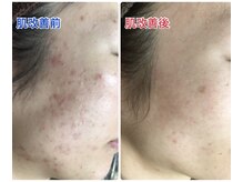 ビエル(Bielle)/繰り返しなる肌の赤み改善