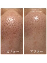 レイラニア(Leilani.Am)/毛穴エクストラクション