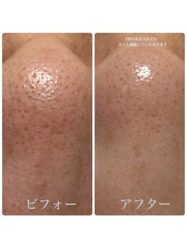 レイラニア(Leilani.Am)/毛穴エクストラクション