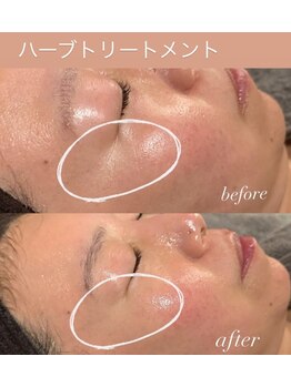 ランプ(LAMP)/最高峰/ハーブトリートメント