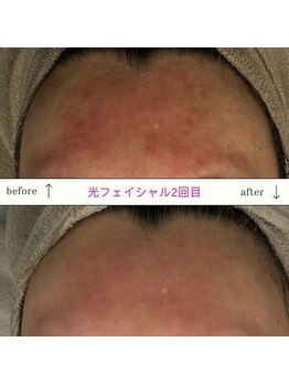 キュオバイアンドリープ(Qo by &LEAP)/光フェイシャル/beforeafter