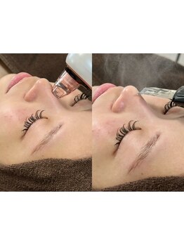 毛穴ケアをしたい