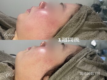 シルビー(CILBE)/プラチナクレイピール