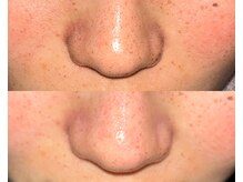 ル シーニュ/毛穴洗浄×スノーピール