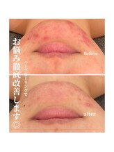 サロン ド リリー(salon de lily)/REVIハーブピーリング