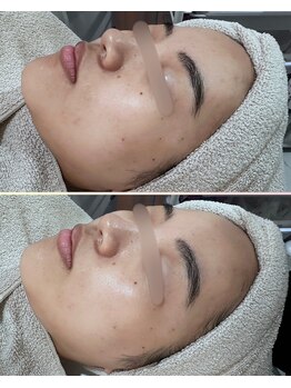 ソワナ(soina)/【神楽坂駅/フェイシャル/毛穴】