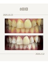 ホワイトニングショップ 福岡姪浜店/お客様before after