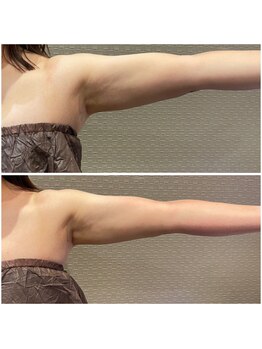 ビュウナ 銀座(BEAUNA)/脂肪冷却/frozen8