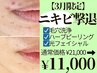 【3月限定ニキビ徹底ケア】毛穴洗浄+ピーリング+光フェイシャル¥21000→