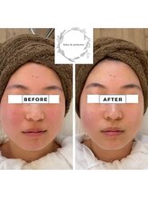 サロン ド パーフェクション(Salon de Perfection)/小顔リフト