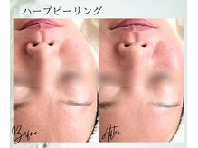 ポノ 茅ヶ崎(Pono.)/湘南/毛穴/ハーブピーリング