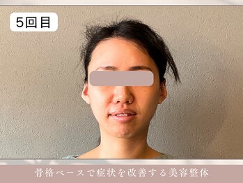 ほぐし屋 かすがい/5回目/小顔リフト+美姿勢整体