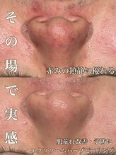 サロン ド マキ(Salon de Maki)/肌荒れや赤みにお悩みの方必見☆