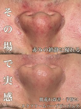 サロン ド マキ(Salon de Maki)/肌荒れや赤みにお悩みの方必見☆