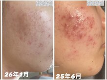 ナオフクオカ ヒーリングフォースエヌ(NaoFukuoka/healingforceN)/ハーブピーリングで肌育陶器肌！