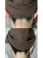 ミース 札幌中央店/うなじ矯正ビフォーアフター