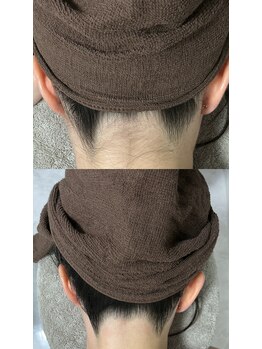 ミース 札幌中央店/うなじ矯正ビフォーアフター
