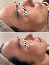 オーパーツ(OOPARTS)/ハーブピーリング/下北沢/新宿