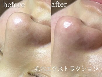 エーアール(ar)/毛穴エクストラクション