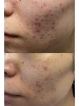 ルーク(Luke)/ニキビケア