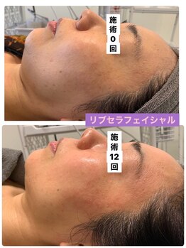 プリュネル(Prunelle)/プラズマシャワー