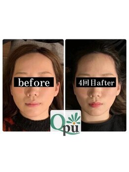 キュープ 浜松店(Qpu)/イベント前に更に小顔へ^^