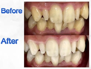 LBSホワイトニング 梅田店/ホワイトニングビフォーアフター