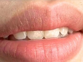 ルネル(Lunelle)の写真/気になる色ムラを整え、韓国発の"ドールピンク"で可憐な桜色トーンへ♪自然なベビーピンクへ導く最新ケア★