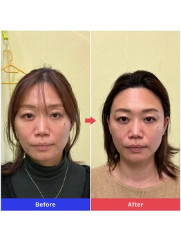 整音(totonone)/3回目小顔・頭のサイズ感