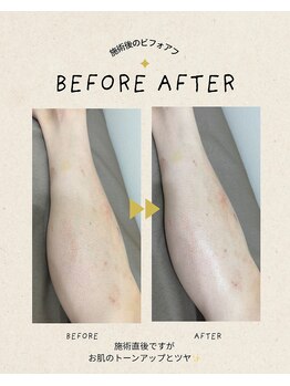 カラン ザ ビューティー(Calin the beauty)の写真/速攻美白効果に期待！全身脱毛（顔.vlo込み）11000円で、つるスベ肌へ導く★