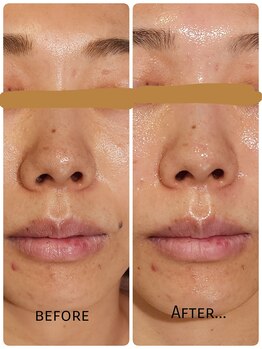 サロン ドゥ メビウス 春日店(salon de mebius)/毛穴/ハリ/つや/透明感/くすみ