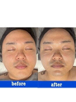 ダリア(Dahlia)/メンズハーブピーリング