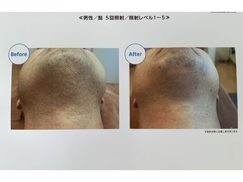 ドゥマイン(Do Mynd)/ヒゲ脱毛