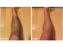 セラス(CERAS)/男性の足脱毛