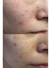 ルーク(Luke)/ニキビケア