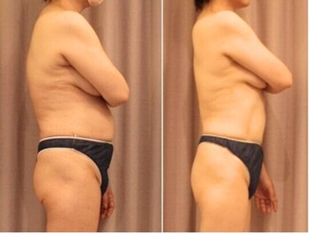 ファニービー 吹田店/痩身モンスター