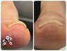 【親指の軽度巻き爪でお悩みの方】特殊技術での親指2本矯正*ワンカラー￥13800