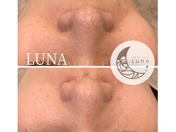 ルーナ(LUNA)/☆ハイドロスキン1回施術結果☆