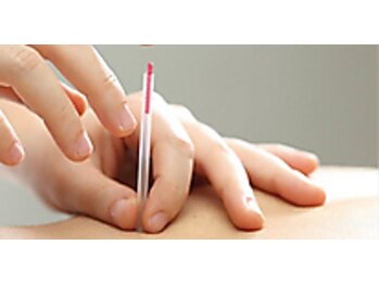 むげん整骨院鍼灸院 桃山大手筋/美容張鍼でお肌の活性化◎