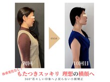 エソア(esoa)/40代　小顔矯正