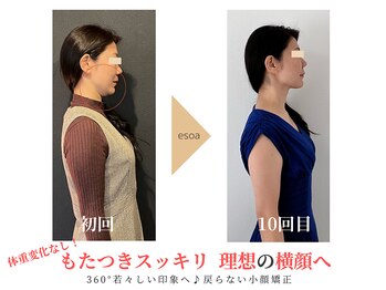 エソア(esoa)/40代 小顔矯正
