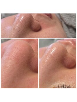 ピエナ(Piena)/毛穴セットメニュー!