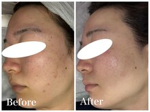 ノア 新宿(Noa)/ハーブピーリング＋マシン 6回