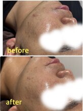 ココサロン(Coco Salon)/肌荒れでお悩みの方